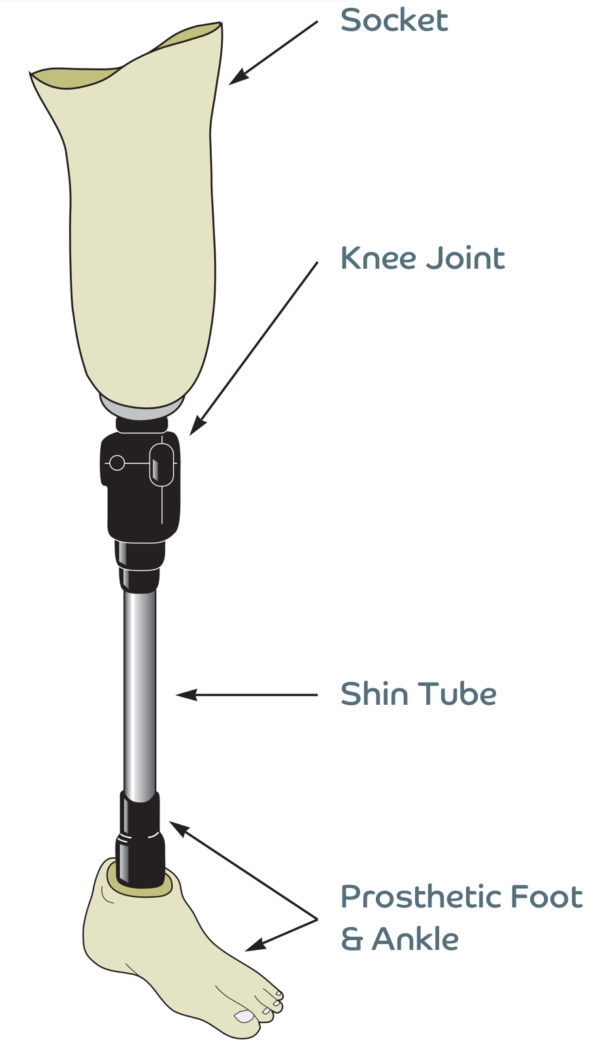 Above Knee Prosthesis - Endolite